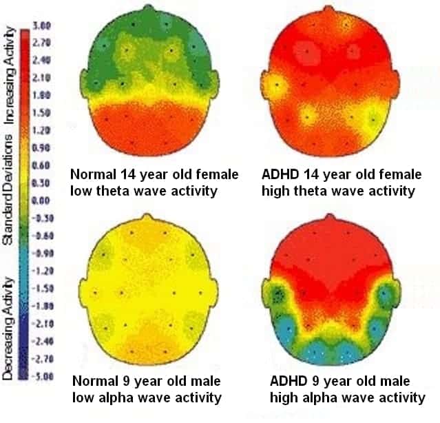 Four brain pictures showing the EEG brain mapping. On the left site the images show low theta and alpha activities of normal subjects. On the right site the corresponding images show higher theta and alpha activity by ADHD children. This EEG brain mapping also supports the neurobiology of the brain as root cause of ADHD