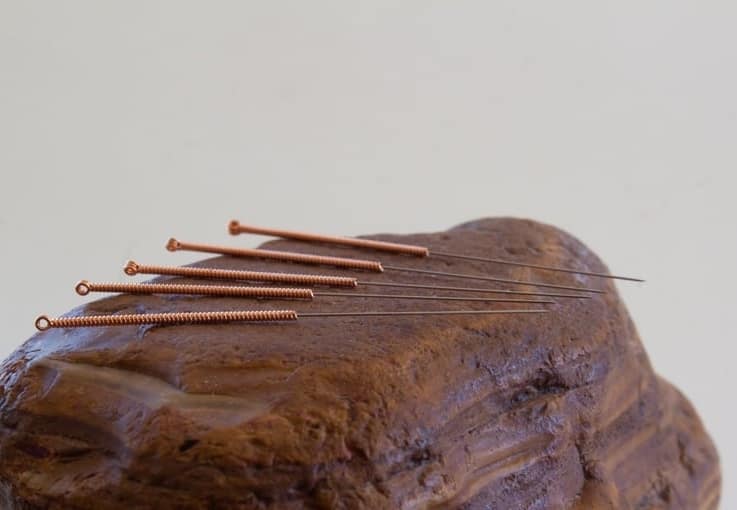 Acupuncture in integrative treatment for depression. The picture shows acupuncture needles